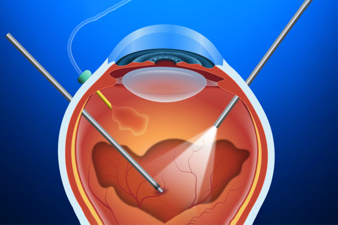 Vitrektomi ve Retina Cerrahisi Vitrektomi ve Retina Cerrahisi